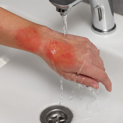 A hand with burns being held under cold water.
